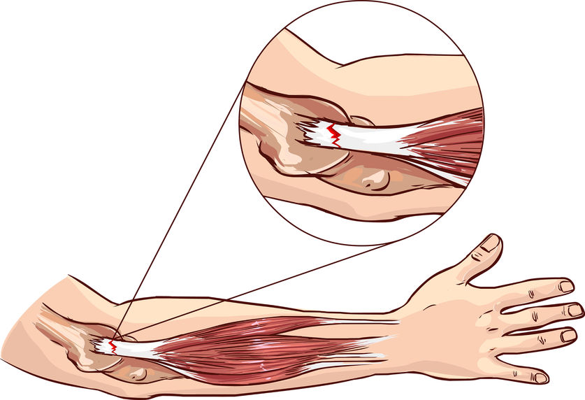 5 Common Signs That You Have Tennis Elbow