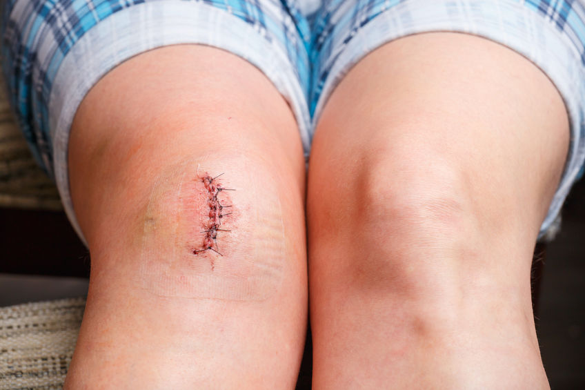 6 Reasons Why Your Knee Surgery Recovery Is Taking Longer Than Expected