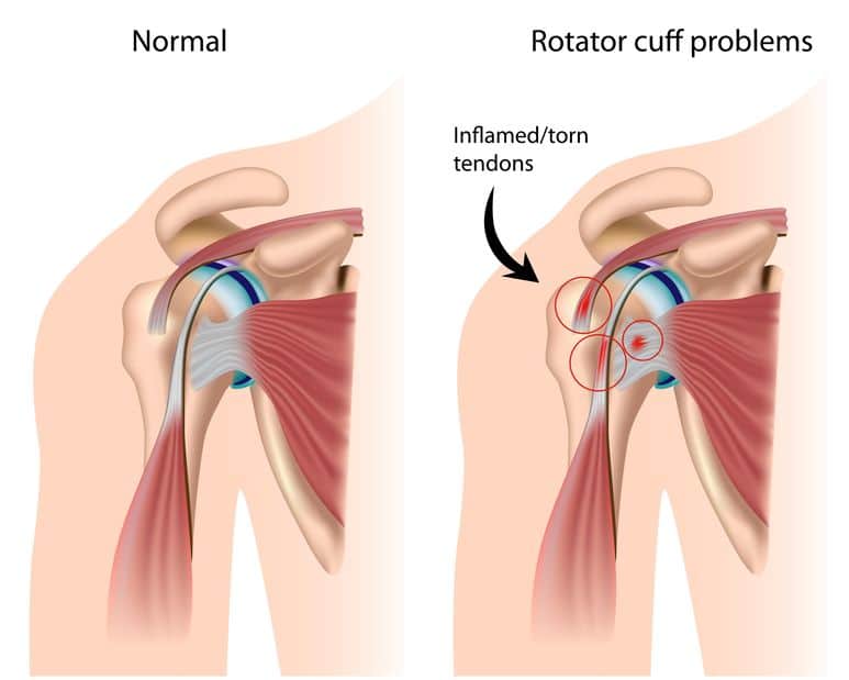 How To Tell If You Have a Damaged Rotator Cuff? Shoulder Anatomy